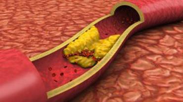 Aterosklerose av karene - symptomer, årsaker og behandling