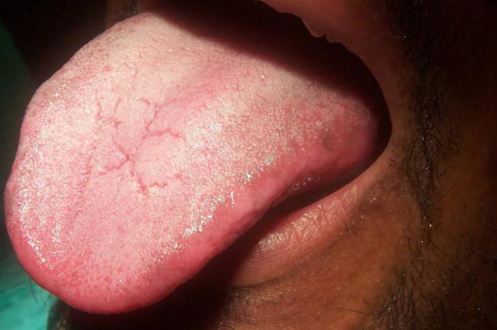 kroniske candidiasis symptomer