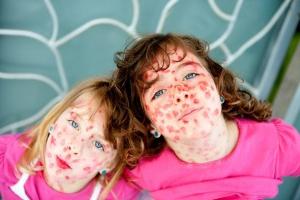 Measles i et barn: symptomer og behandling