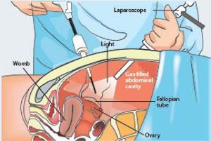 laparoskopi i gynekologi