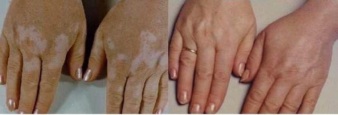 Lotion fra vitiligo 