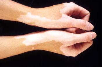 Uforklarte hvite flekker på huden - hva er det?