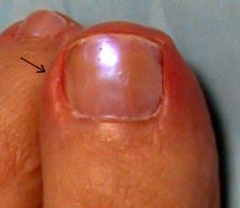 Spiken vokste inn i en finger: årsakene og behandlingen