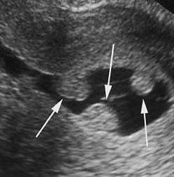 Polyposis av livmorhalsens endometrium