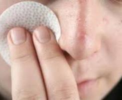Årsakene til akne i ansiktet og hvordan bli kvitt dem
