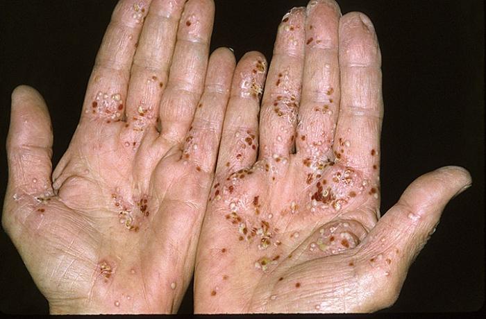 Psoriasis: et symptom som vil indikere sykdommen