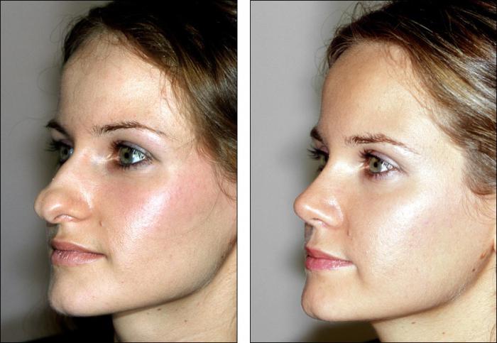 etter rhinoplasty nese