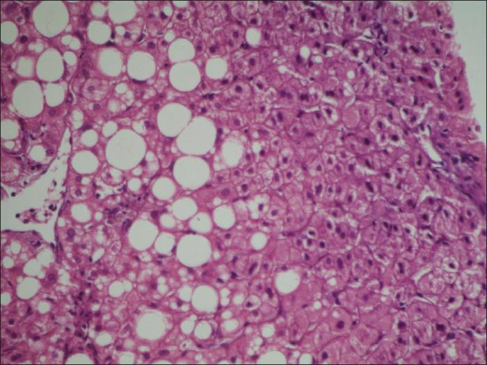 steatohepatosis av leveren