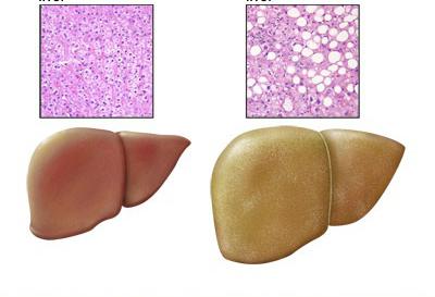 steatohepatosis symptomer